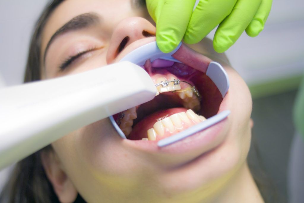 Symptoms of Ill Fitting Dental Bridge at Anoka Dental